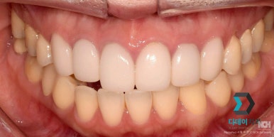 Laminated Veneer Removal: If You Want It Done Safely Without Pain, Check Just One Thing image 11