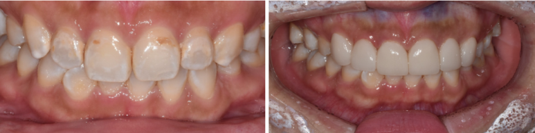 최소삭제라미네이트, 비용부터 치과 고르는 방법 관련 이미지 4