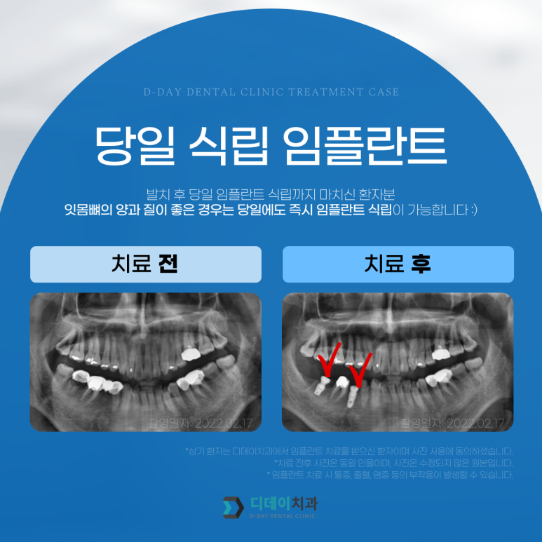 원데이임플란트, 정말 하루만에 가능할까요? 관련 이미지 5