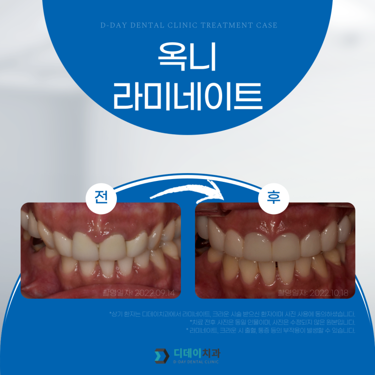 강남라미네이트 잘하는 곳 선택법, 치과의사가 알려드립니다. 관련 이미지 10