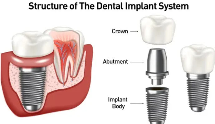 Dental Implants at Seolleung Station: One Choice Can Change the Next 10 Years image 1