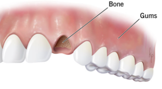 40대 전체 임플란트, 아직 젊은데 치아를 전부 발치해야만 하는 걸까? 관련 이미지 7