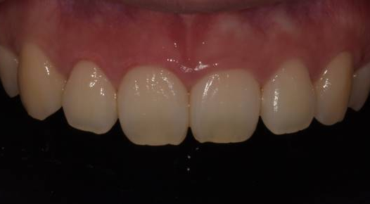 잇몸성형후기, 사례가 없어 고민하셨던 분만 관련 이미지 8