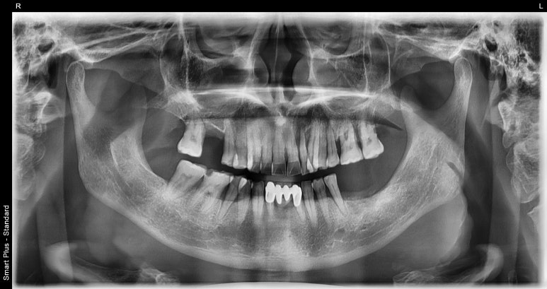 임플란트브릿지? 치아 개수대로 임플란트 심지 않아도 됩니다 관련 이미지 2