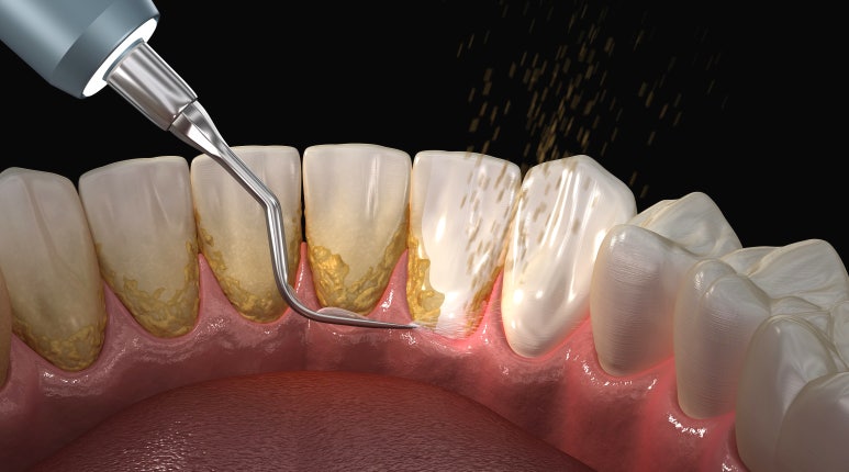 앞니라미네이트가격에 관한 정보, 낱낱이 공개합니다. 관련 이미지 5