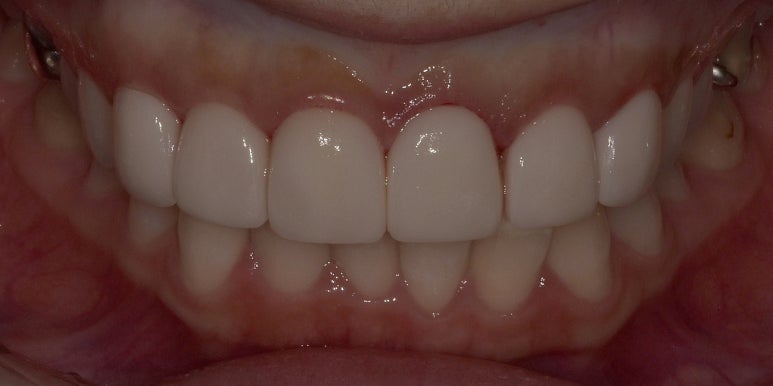 라미네이트 치아삭제? 무삭제만이 정답은 아닙니다. 관련 이미지 7