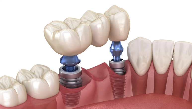 고령자임플란트 보험 적용받을 때 주의할 점 관련 이미지 7