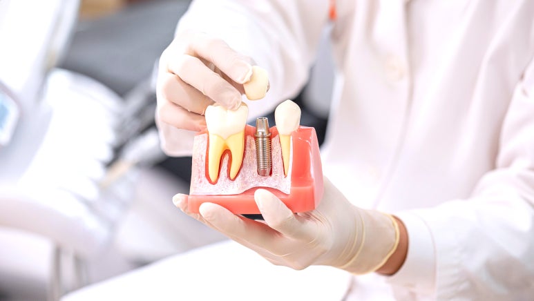 국산임플란트재료? 가격 걱정이 있으시다면 확인하세요. 관련 이미지 2