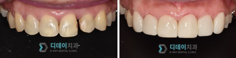 벌어진치아, 교정하지 않고 앞니틈새를 메우는 방법 관련 이미지 5