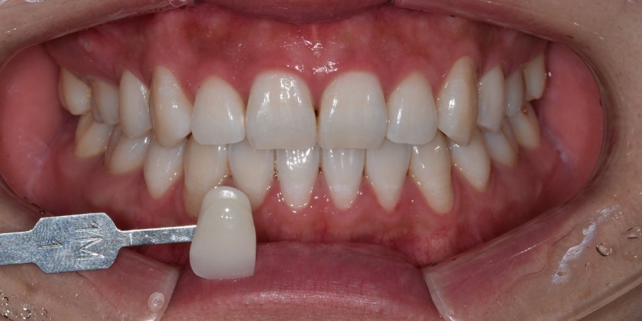 최소증상 치아미백 치과 후기,일본에서도 오는 이유? 관련 이미지 6