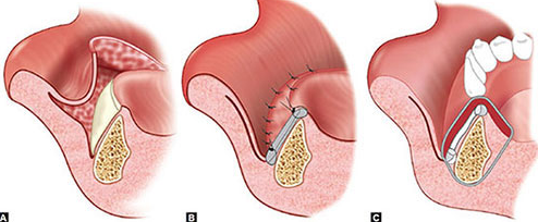 구강전정술 잘하는곳? 이 2가지 모르면 못찾습니다 관련 이미지 4