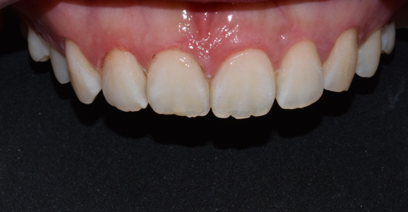 치은절제술/성형술? 잇몸이 치아를 덮고 있어 고민인 분만 관련 이미지 4