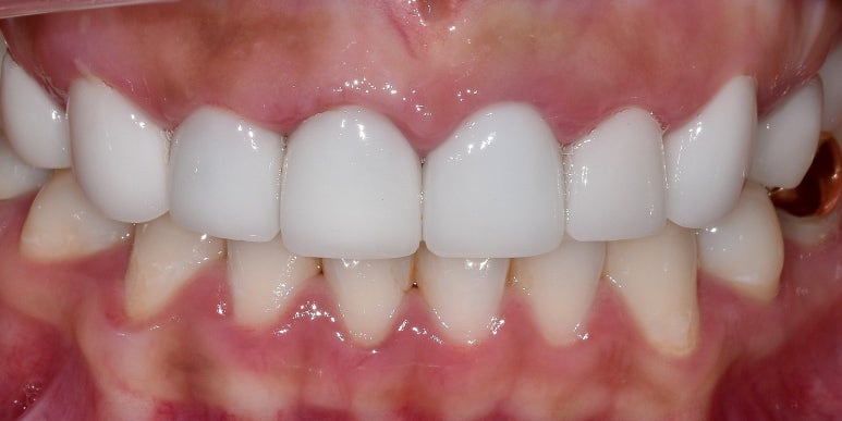 라미네이트올세라믹, 차이점과 치료사례까지 모두 공유합니다. 관련 이미지 10