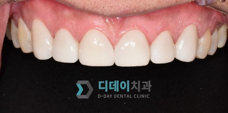 라미네이트후기, 치료사례만 모아 보여드립니다 관련 이미지 10