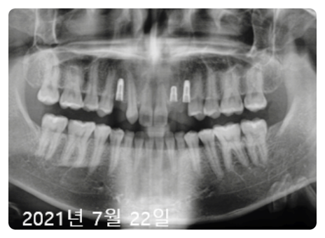 앞이빨임플란트? 3가지 원칙부터 확인하세요. 관련 이미지 2