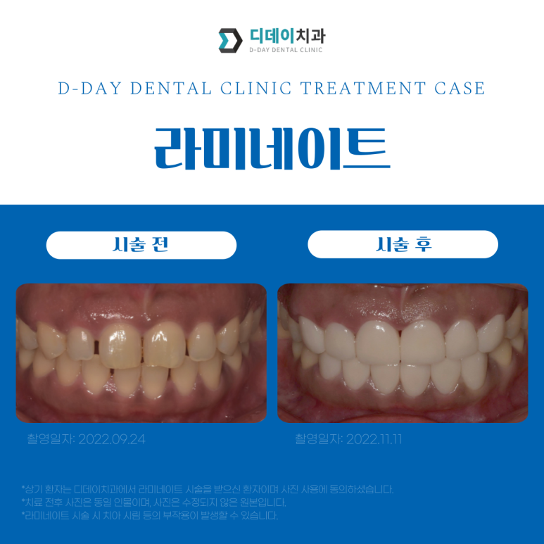 강남라미네이트 잘하는 곳 선택법, 치과의사가 알려드립니다. 관련 이미지 9