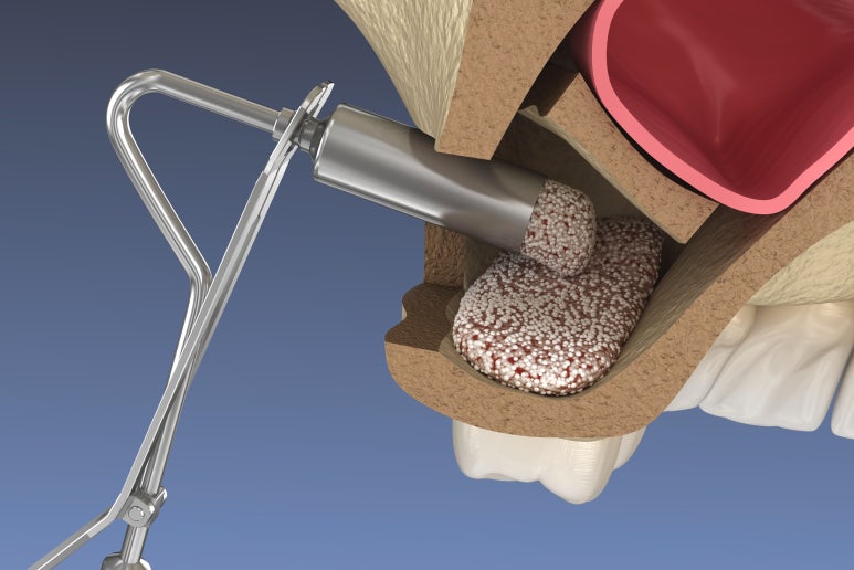 임플란트상악동거상술, 통증은 OO 때문이다? 관련 이미지 7