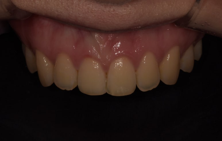 앞니성형? 라미네이트 없이 치아성형하는 방법 관련 이미지 5