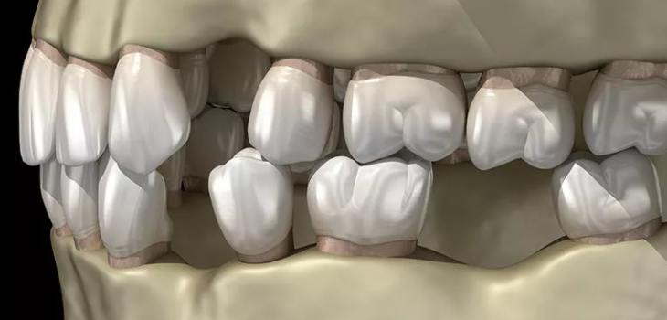 40대 전체 임플란트, 아직 젊은데 치아를 전부 발치해야만 하는 걸까? 관련 이미지 6