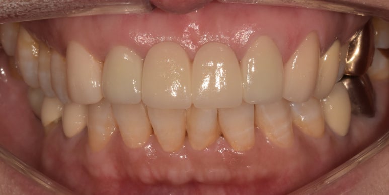 앞니브릿지, 오래된 브릿지교체하신 치료사례와 비용공개합니다. 관련 이미지 12