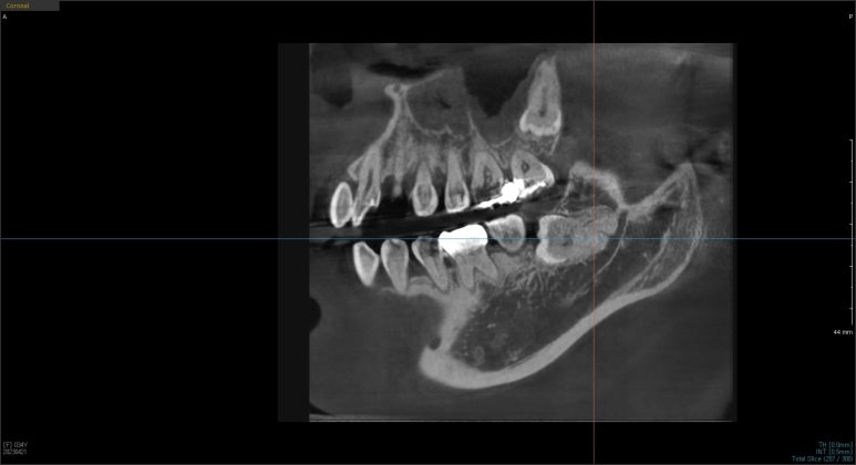 사랑니발치비용, 단계별로 세세히 알려드립니다. 관련 이미지 4