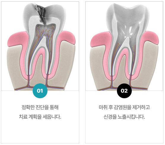 충치치료기간, 치료별 내원횟수와 기간까지 총정리 관련 이미지 8