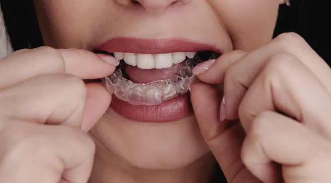 선릉 투명교정 시작 전, 반드시 확인할 체크리스트 관련 이미지 6