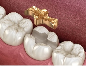 치아인레이가격, 강남은 비싸다? 이런 편견, 저희가 깨뜨리겠습니다. 관련 이미지 3