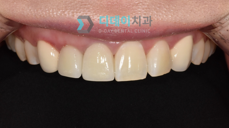 앞니크라운빠짐, 탈락한 경우 재부착 가능할까요? 관련 이미지 3