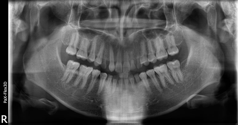 네비게이션임플란트가격, 일반 임플란트보다 비싼 이유? 관련 이미지 6