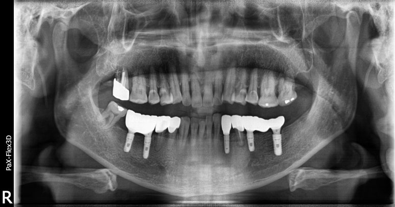 임플란트건강보험, 추가비용 없이 가능할까요? 관련 이미지 6