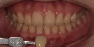 치과미백비용? 효과? A 부터 Z까지 탈탈 털어 알려드립니다. 관련 이미지 6