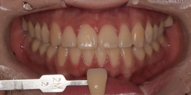 치아다듬기, 만만하게 생각할 치료는 절대 아닙니다. 관련 이미지 6