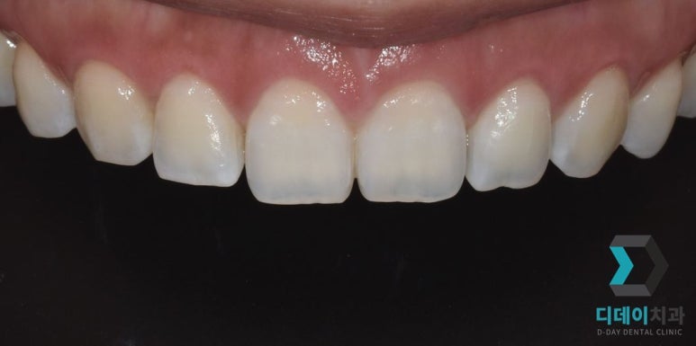 웃을 때 잇몸이 많이 보인다면, 몰라서 못하는 이것 관련 이미지 8