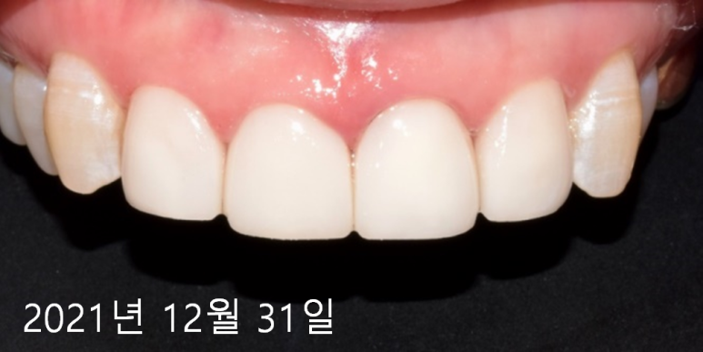 라미네이트떨어짐, 깨짐의 진짜 원인은 따로 있다? 관련 이미지 5