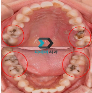 Why Does Acute Pulpitis Occur? The Answer Is Obvious. image 4