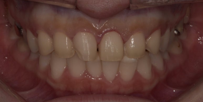 라미네이트 치아삭제? 무삭제만이 정답은 아닙니다. 관련 이미지 5