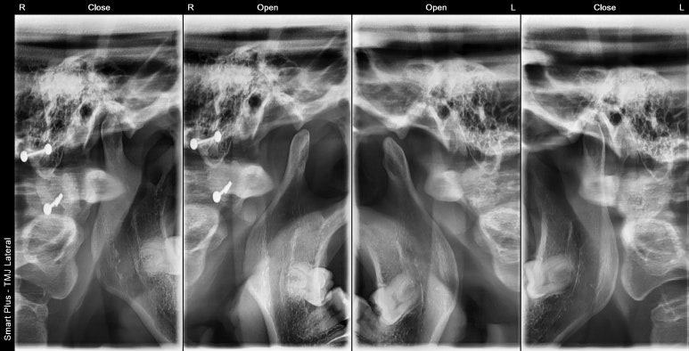턱에서딱딱소리날 땐 관련 이미지 4