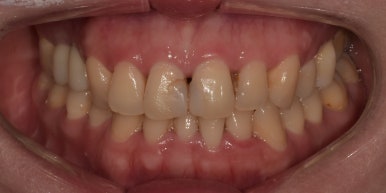 라미네이트후기, 닳아있고 변색된 치아 치료한 최신사례 관련 이미지 6