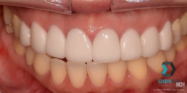 Laminated Veneer Removal: If You Want It Done Safely Without Pain, Check Just One Thing image 12