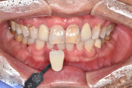 치아미백유지기간부터 종류, 주의사항까지 알려드립니다 관련 이미지 3