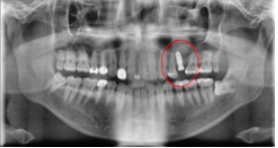 임플란트교체? 걱정되시는분들만 보세요. 관련 이미지 4