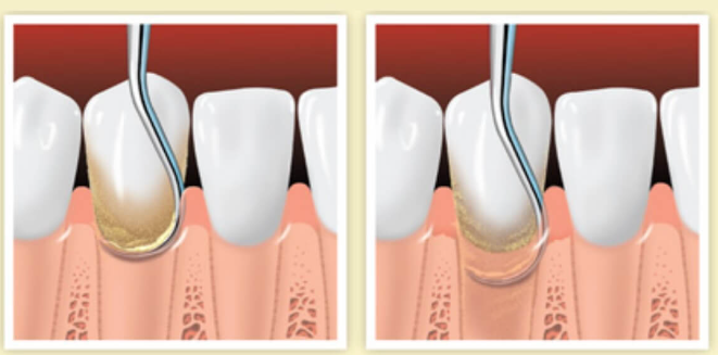 강남 치주잇몸소파술 치과, 손해 보기 싫다면? 관련 이미지 4