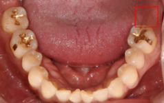 임플란트후붓기? 걱정하시던 환자분 치료 과정 관련 이미지 3