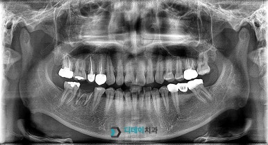 역삼동 임플란트 뼈이식 필요성부터 통증까지, 이 글 하나만 보시면 됩니다. 관련 이미지 1