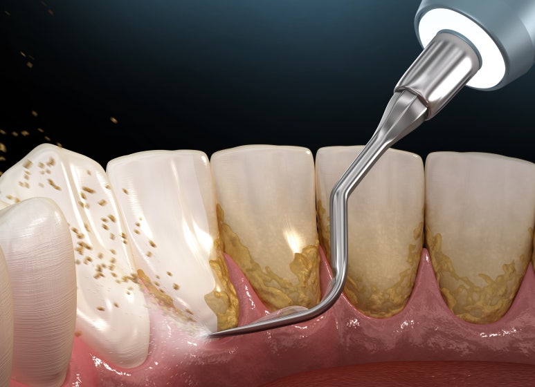 20대잇몸퇴축? 이식수술만이 답은 아닙니다. 관련 이미지 6