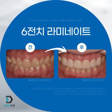 앞니성형, 종류별 가격과 전후사진까지 완벽 정리 관련 이미지 3
