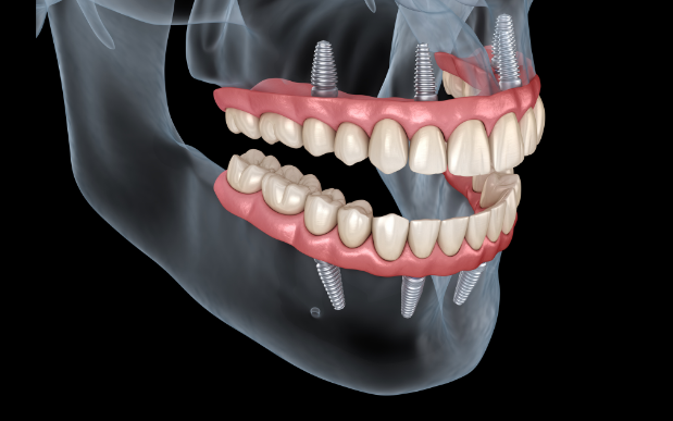 40대 전체 임플란트, 아직 젊은데 치아를 전부 발치해야만 하는 걸까? 관련 이미지 2