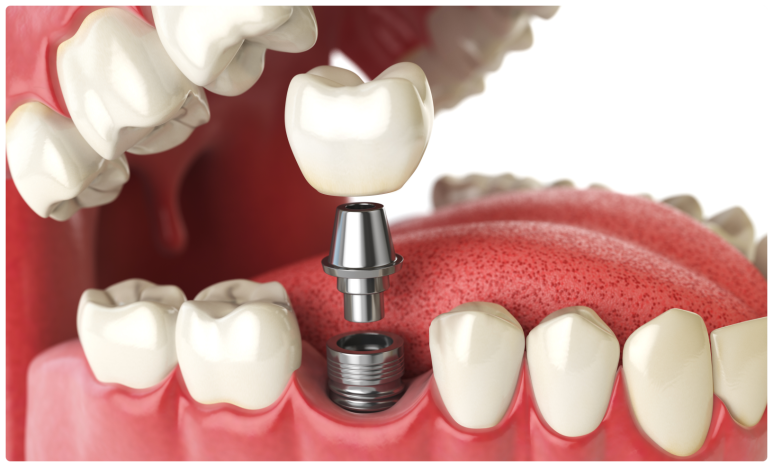 아스트라임플란트? OO부터 확인하세요. 관련 이미지 1