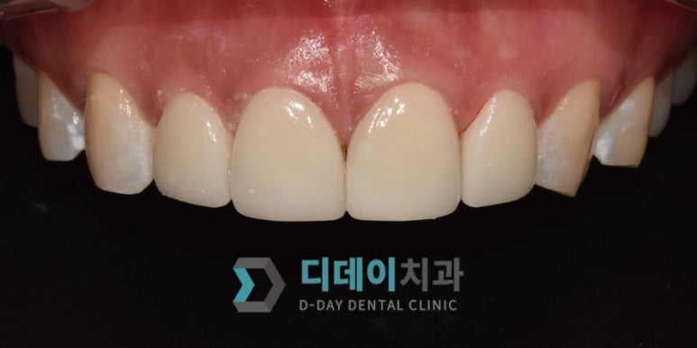 작은이빨, 왜소치? 치아 크기를 키우고 싶은 분만 <필독> 관련 이미지 8